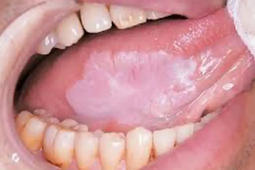 白板症（前癌病変）